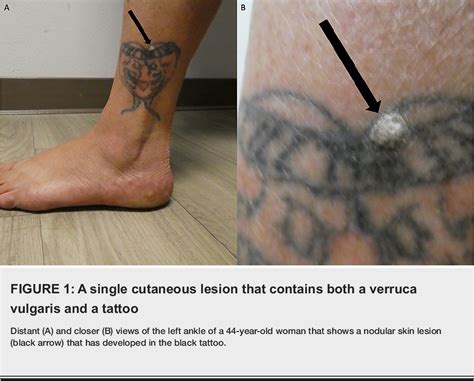 liquid nitrogen tattoo|Verruca Vulgaris Occurring on a Tattoo: Case Report and Review .